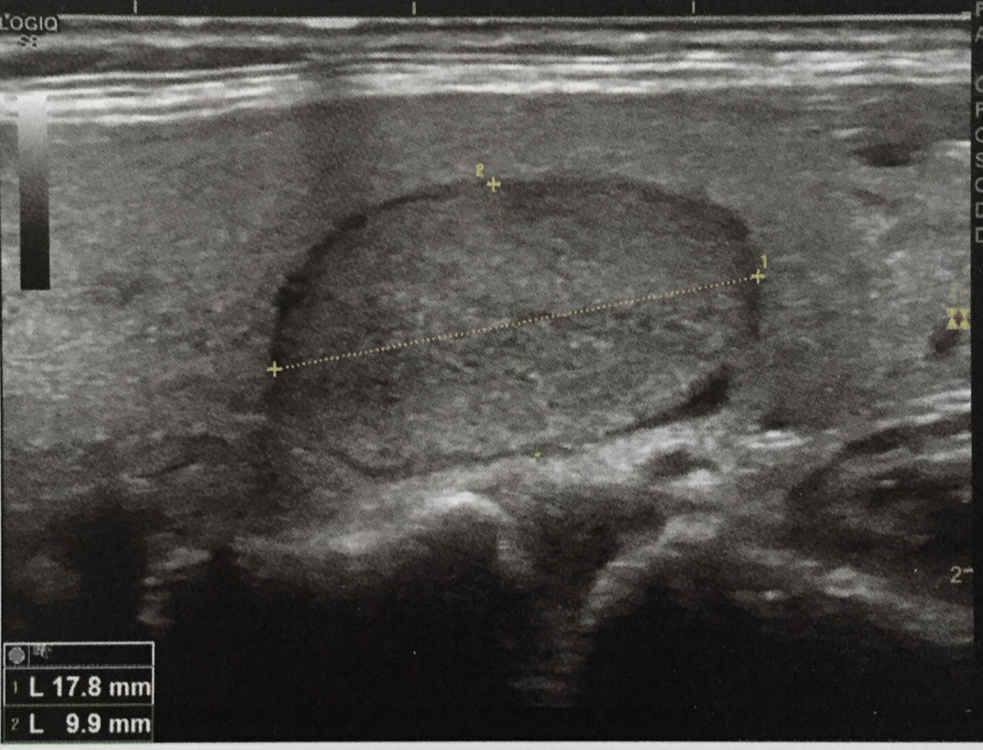 Nodule