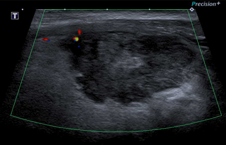 Nodule Irrég