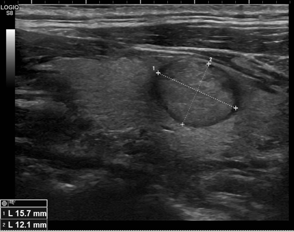 Nodule TIRADS 3 (1)