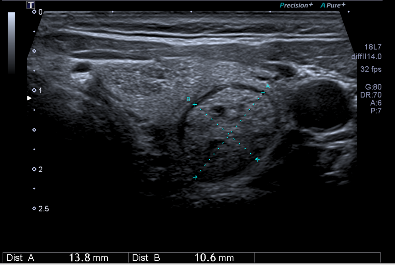 Nodule TIRADS 3 bis - Copie