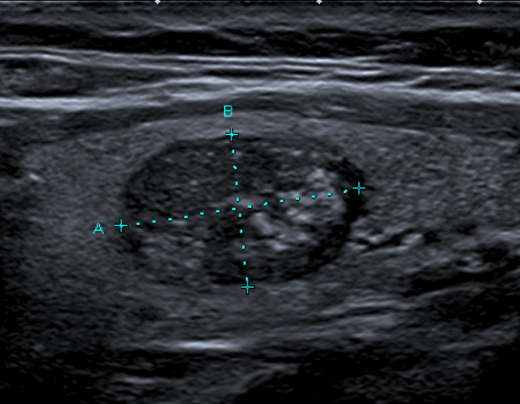 Nodule TIRADS 5